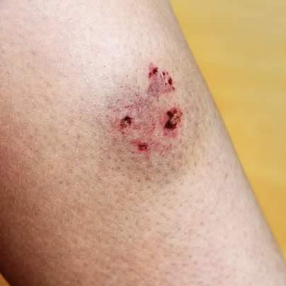 Deep Puncture