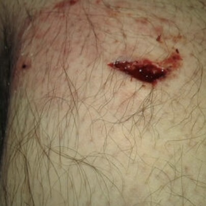 Multiple/Torn Wounds